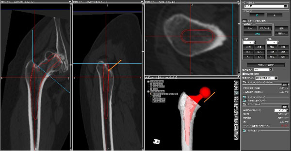 人工股関節の術前計画 大腿骨側ステム設置