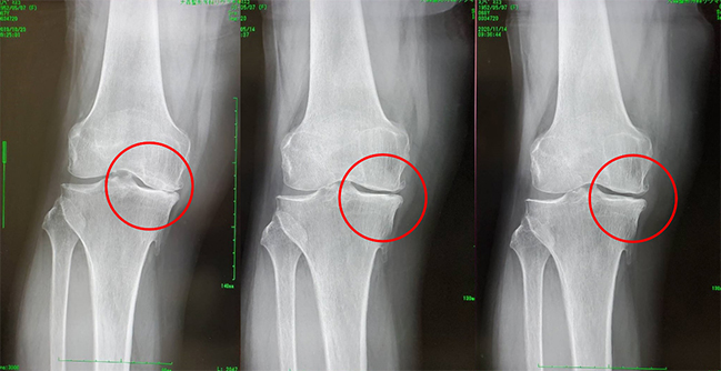 変形性膝関節症（内反型）68歳・女性