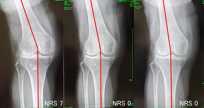 変形性膝関節症（外反型）69歳・女性